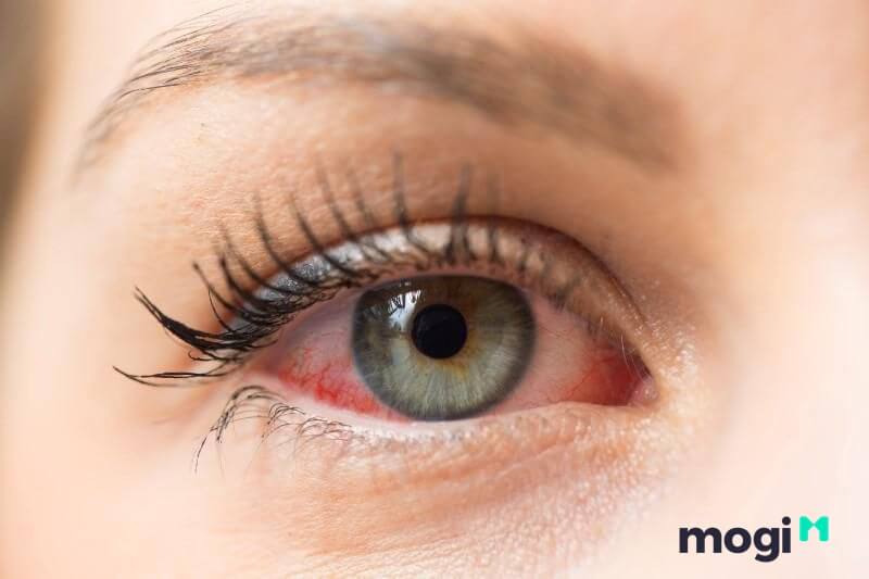 Nháy mắt là điềm báo hay bệnh? Có đáng lo ngại? 4 Theo khía cạnh Mocbai666 tải ứng dụng thì mí mắt bị co giật chính là dấu hiệu cảnh báo vấn đề về sức khỏe của bạn.