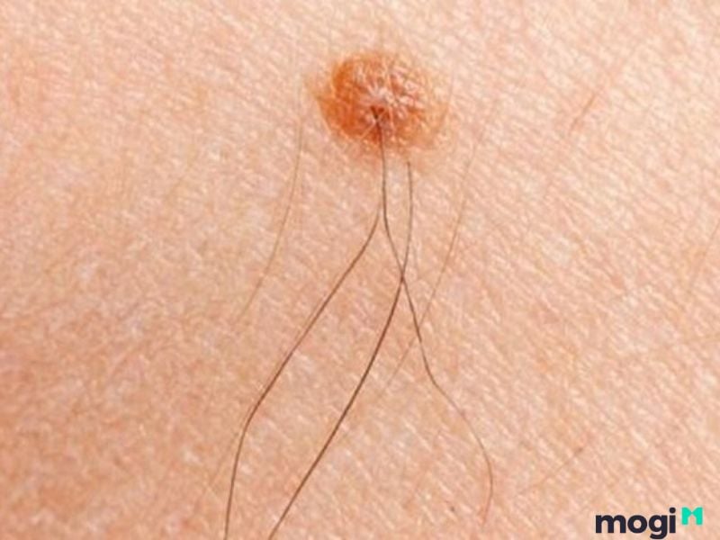 Nốt ruồi dưới cằm và có lông nam