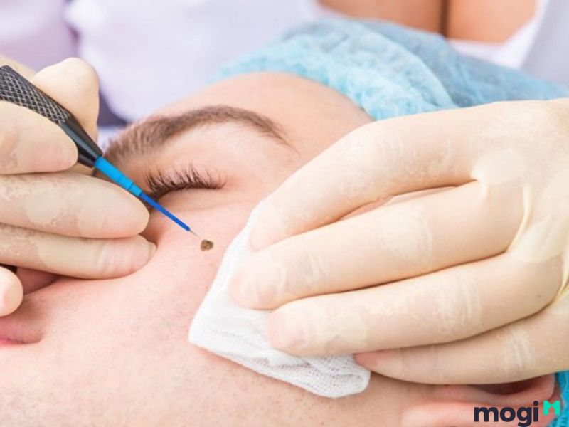 Có nên xóa nốt ruồi dưới cằm?