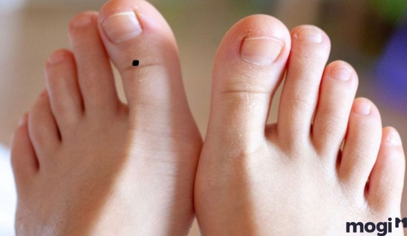 Nốt ruồi ở vị trí ngón cái