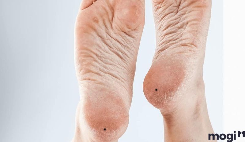 Việc xóa nốt ruồi có cần thiết?