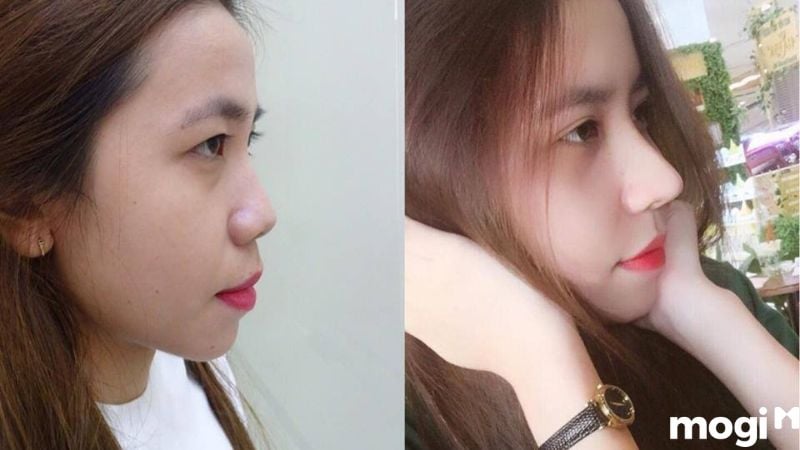 mũi củ tỏi