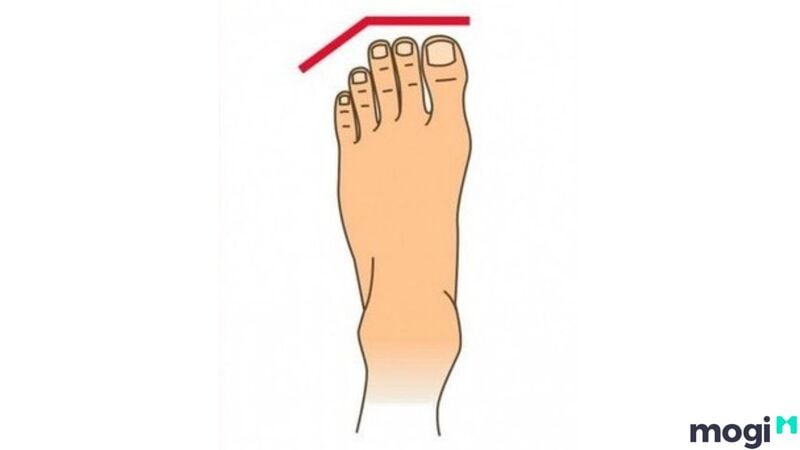 Tướng bàn chân có độ dài 3 ngón đầu tiên gần bằng nhau