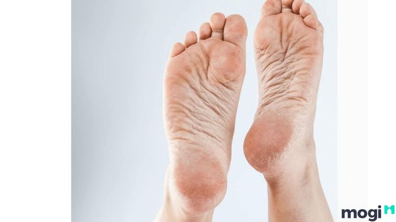 Lòng bàn chân khô cứng cho thấy cuộc đời rất cực khổ