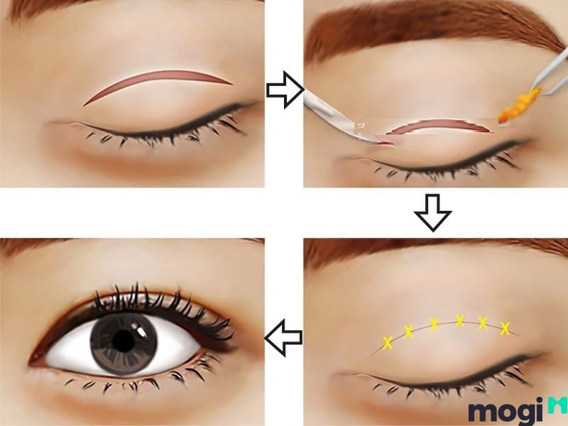 Minh họa quá trình cắt mí thẩm mỹ