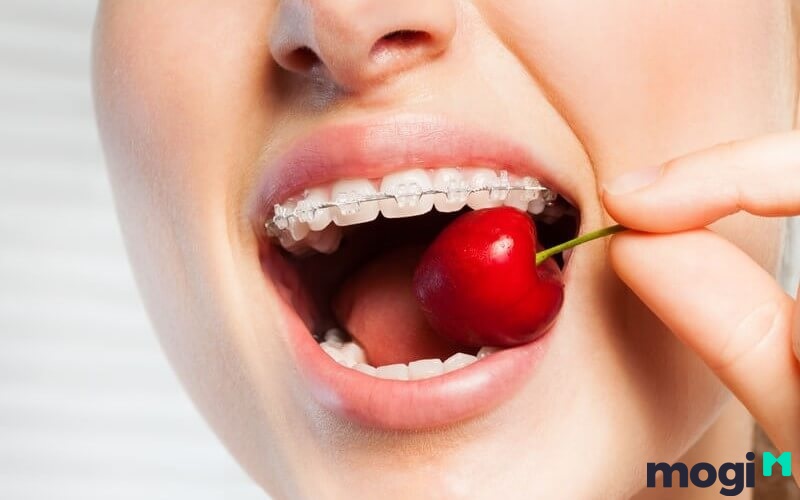 Mặt Chữ Điền Là Gì? Giải Đáp Tướng Số, Vận Mệnh Người Mặt Chữ Điền 20 Khi niềng răng, ăn uống cần hạn chế những thực phẩm cứng