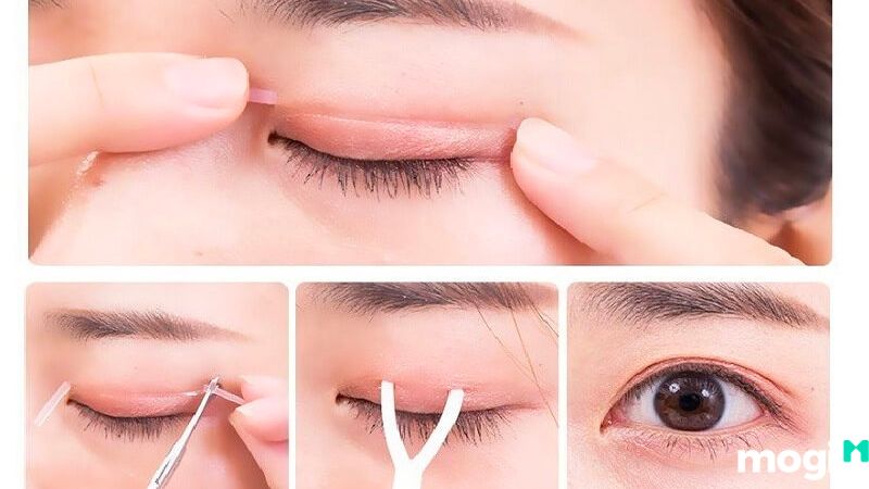 Mắt mí lót là gì?
