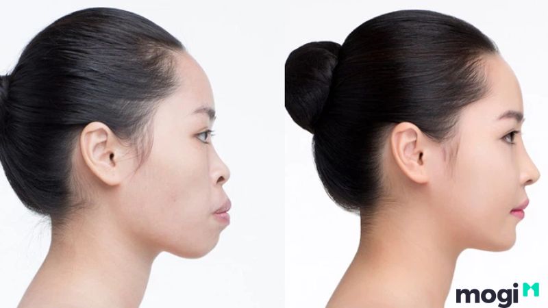 <strong>Cằm Lẹm Là Gì? Bật Mí Bí Ẩn Về Tướng Số Và Cách Cải Thiện</strong> 2 Đặc điểm và biểu hiện của cằm lẹm
