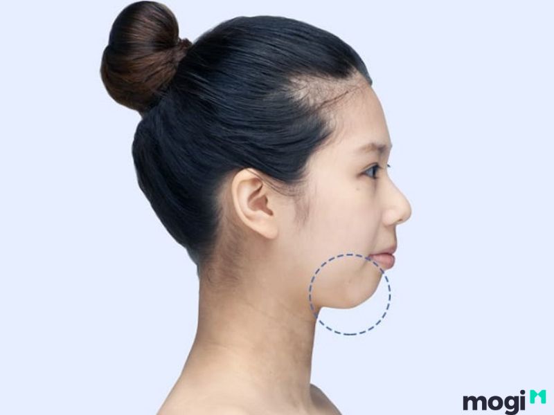 <strong>Cằm Lẹm Là Gì? Bật Mí Bí Ẩn Về Tướng Số Và Cách Cải Thiện</strong> 4 Cằm lẹm do sai lệch khớp cắn