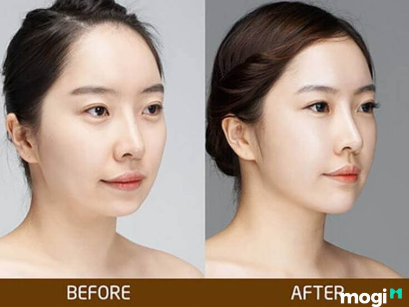 <strong>Cằm Lẹm Là Gì? Bật Mí Bí Ẩn Về Tướng Số Và Cách Cải Thiện</strong> 5 Cằm lẹm do ung thư răng miệng