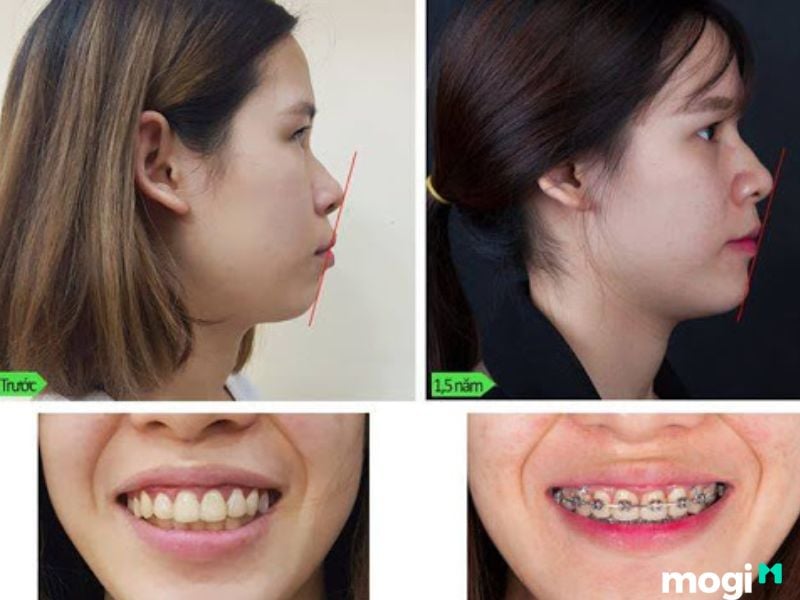 <strong>Cằm Lẹm Là Gì? Bật Mí Bí Ẩn Về Tướng Số Và Cách Cải Thiện</strong> 12 niềng răng chỉnh cằm lẹo