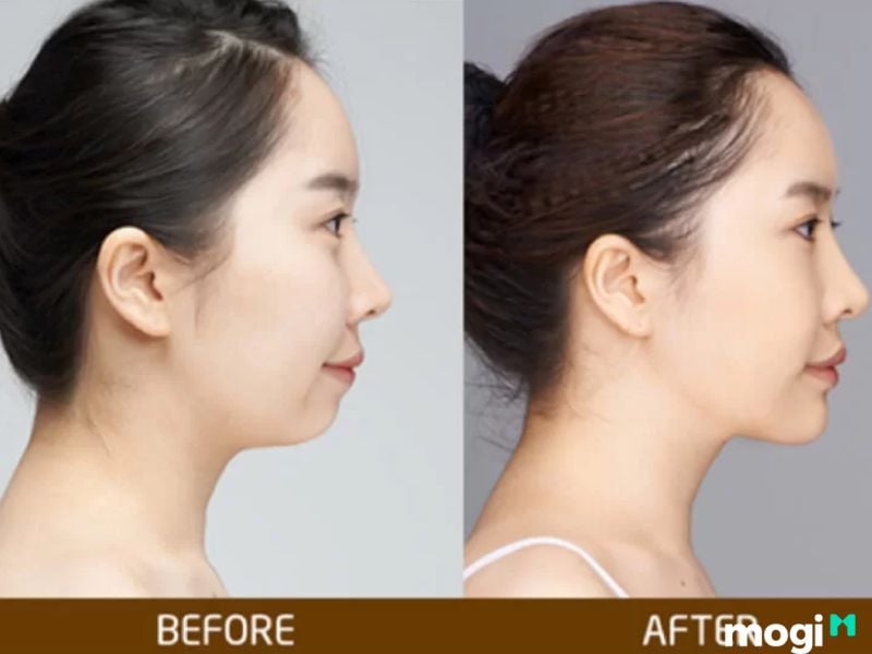 <strong>Cằm Lẹm Là Gì? Bật Mí Bí Ẩn Về Tướng Số Và Cách Cải Thiện</strong> 8 ảnh hưởng của cằm lẹm đến công danh sự nghiệp của nữ giới