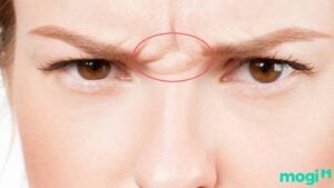 Sơn căn xuất hiện nếp nhăn thường được xem là dấu hiệu Mb6696 cá cược trực tuyến phải suy nghĩ nhiều, dễ gặp áp lực