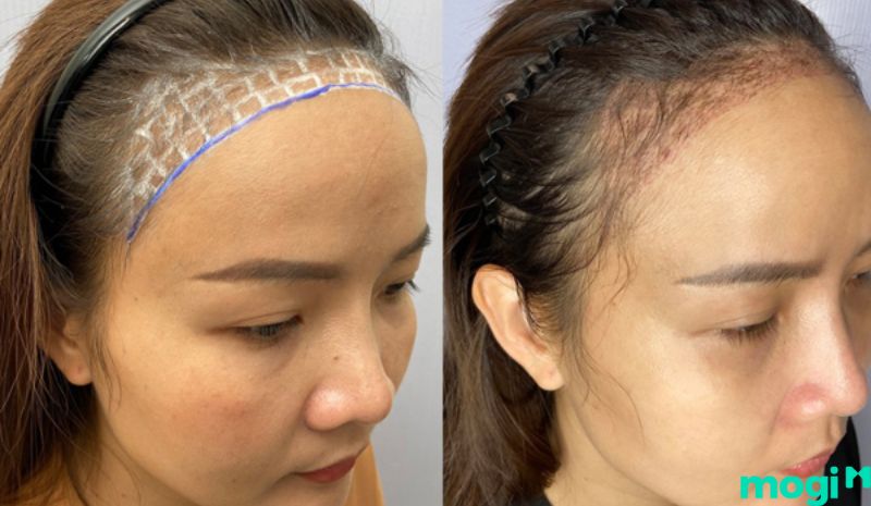 Cải thiện trán chữ M