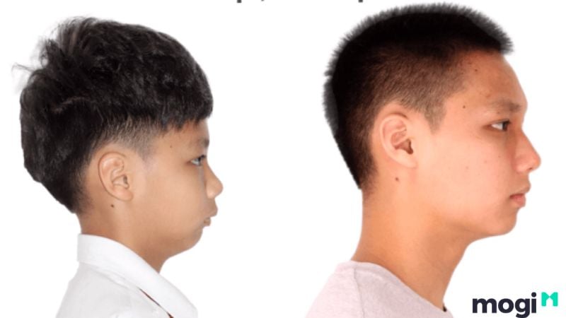 <strong>Cằm Lẹm Là Gì? Bật Mí Bí Ẩn Về Tướng Số Và Cách Cải Thiện</strong> 7 Đường tình duyên của nam giới sở hữu cằm lẹm