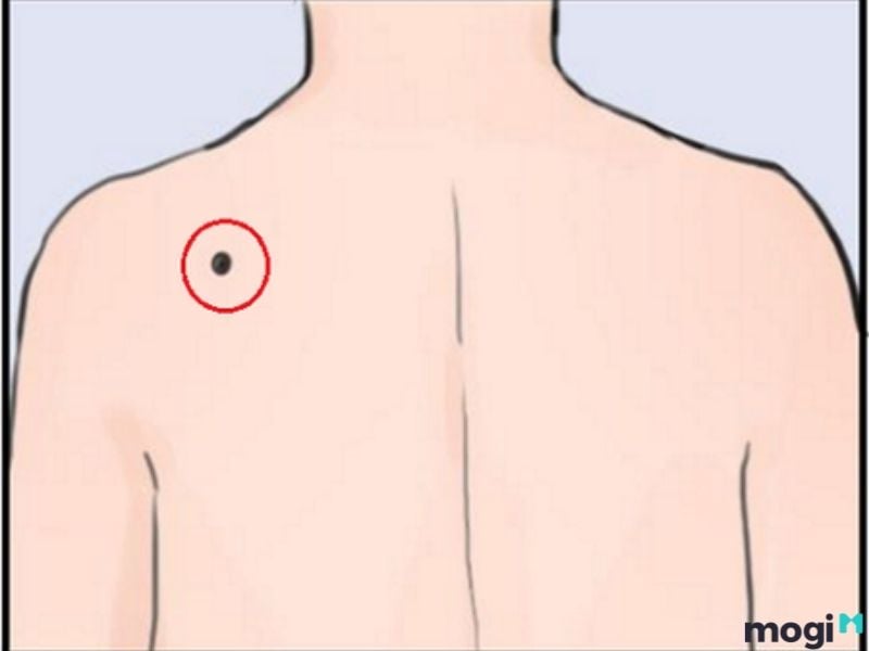 Nốt ruồi ở lưng