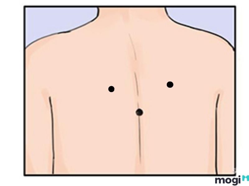 Nốt ruồi ở lưng