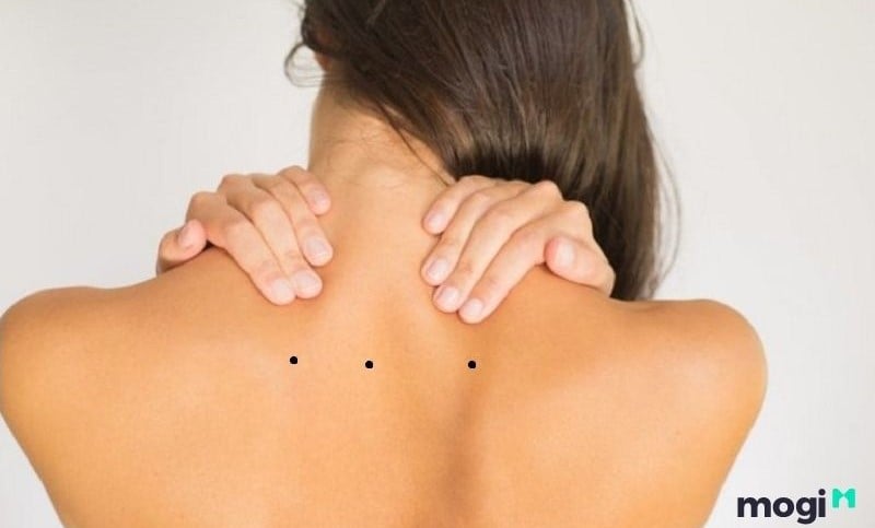 3 nốt ruồi ở lưng là một đường thẳng