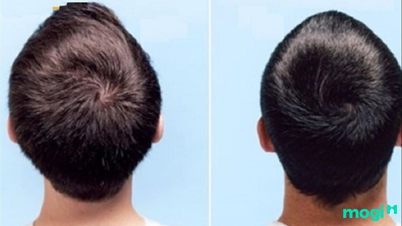 <strong>Xoáy Tóc Là Gì? Các Kiểu Xoáy Tóc Phổ Biến Và Ý Nghĩa Vận Mệnh Các Kiểu Xoáy Tóc</strong> 2 xoáy tóc