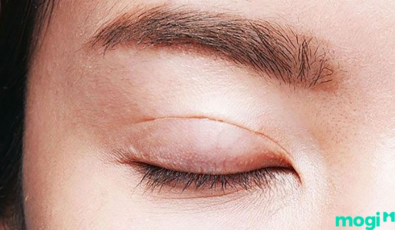 Mắt 1 mí là gì - Cắt mí là một phương pháp để khắc phục mắt 1 mí