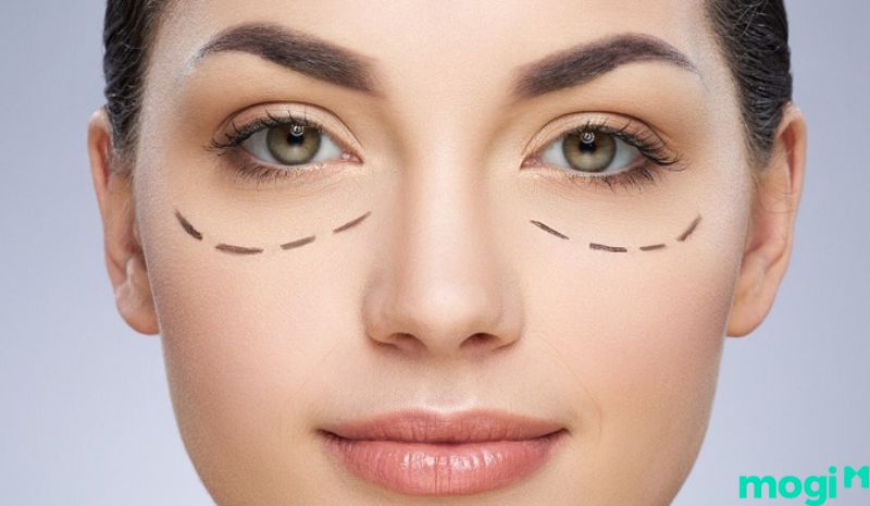 Mắt 1 mí là gì - Phẫu thuật thẩm mỹ bao gồm 5 bước 