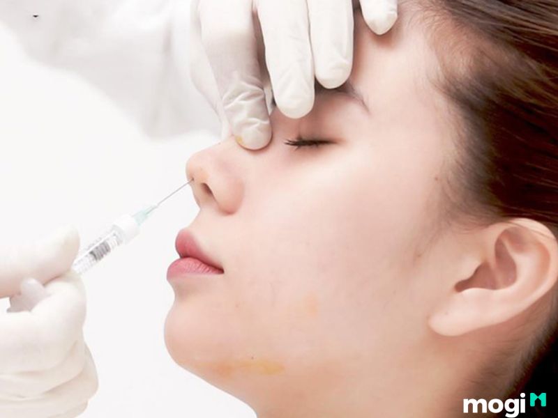 Tiêm filler để thay đổi dáng mũi két