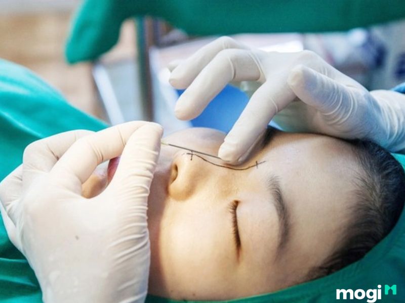 Phẫu thuật để làm thay đổi hình thái mũi két