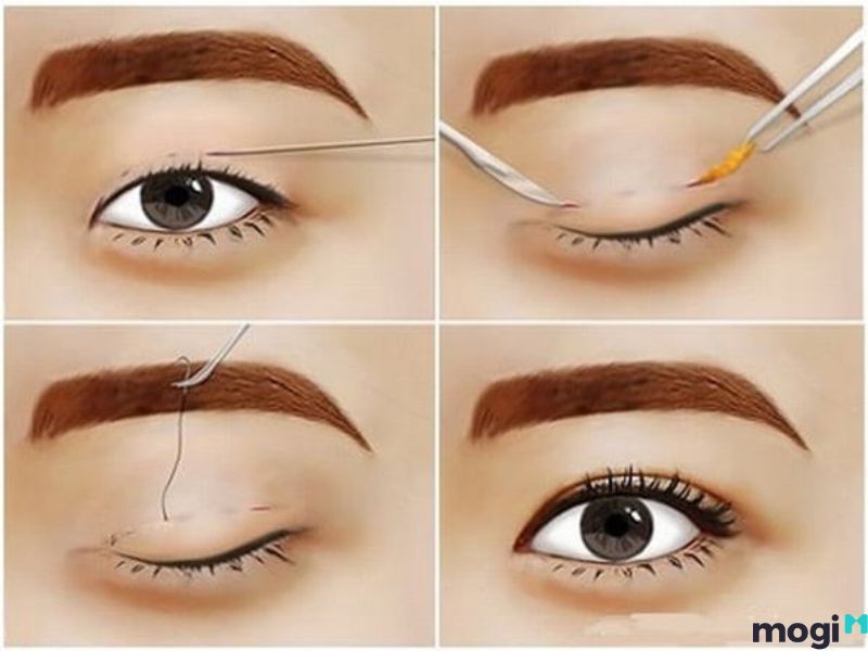 Mắt bồ câu là gì? Sử dụng nhấn mí tạo mắt bồ câu