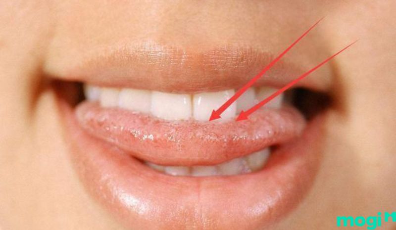 Cắn vào lưỡi là hiện tượng thường gây đau đớn và khó chịu tức thì