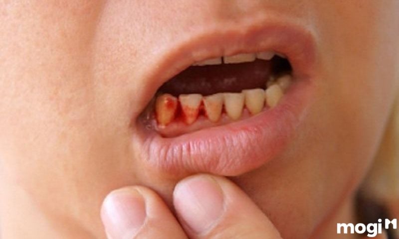 Ngủ mơ thấy máu là điềm gì?