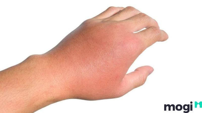 Bị ong đốt là điềm gì?