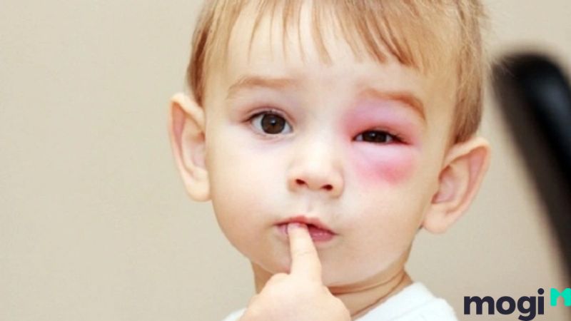 Bị ong đốt là điềm gì?