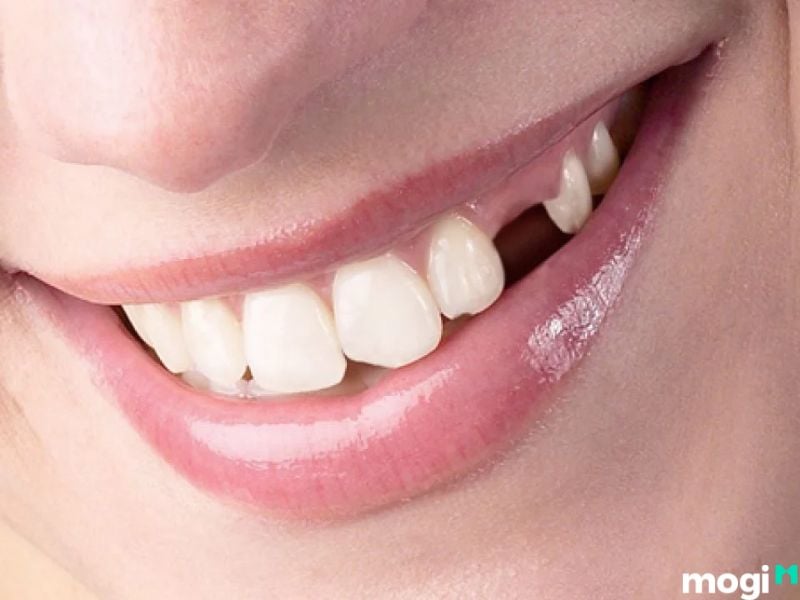 Nằm mơ thấy rụng răng hàm trên